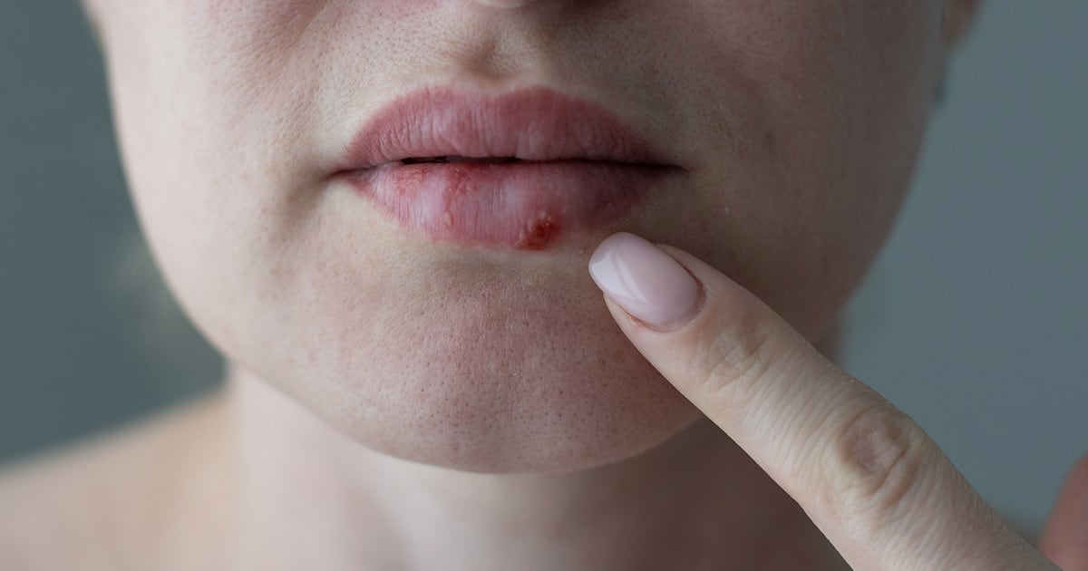 Aprobaron en Estados Unidos un antiviral oral que reabre la pelea contra el herpes resistente