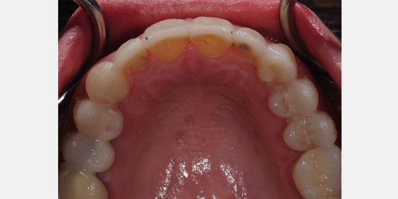 Carillas dentales: la filtracion silenciosa que puede arruinarte una sonrisa y como frenarla a tiempo